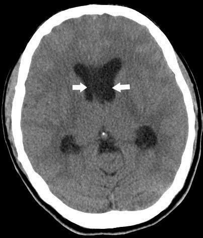 (left): 28 year old female with septum pellucidum subependymoma. Plain ...