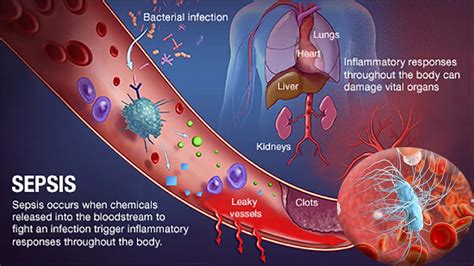 Why have several recent clinical trials of sepsis treatments failed ...