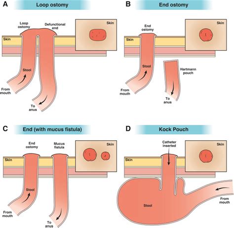 AGA Clinical Practice Update on Management of Ostomies: Commentary - Clinical Gastroenterology ...