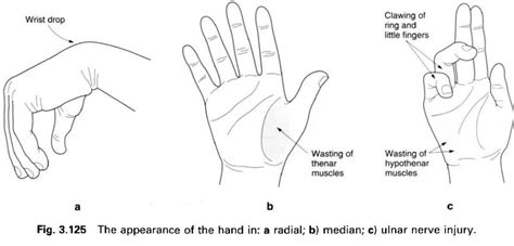 appearance of hand/ muscle wasting in nerve injuries | Hand therapy, Emergency medicine, Ulnar nerve