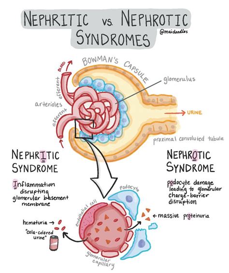 No Time for Kidney-ing Around: Nephritic vs Nephrotic Syndromes | maidoodles | Medical student ...