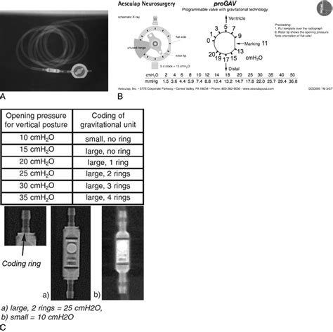 Determining Settings of Programmable VP Shunts | UW Emergency Radiology