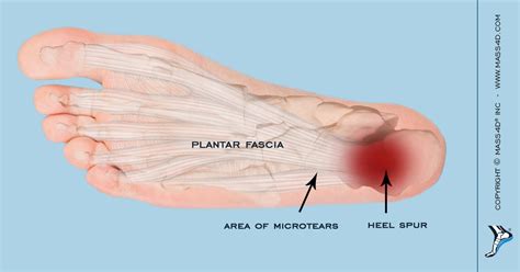 [DIAGRAM] Diagram Of Plantar Fasciitis - MYDIAGRAM.ONLINE