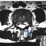 Presurgery sagittal T1-weighted image. A hypointense mass (arrow) is... | Download Scientific ...