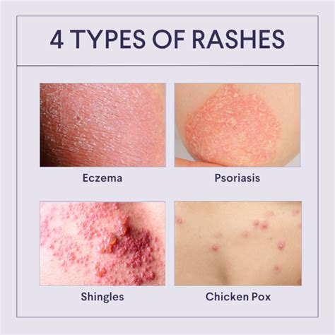 How to help stop a rash from spreading, according to skin experts