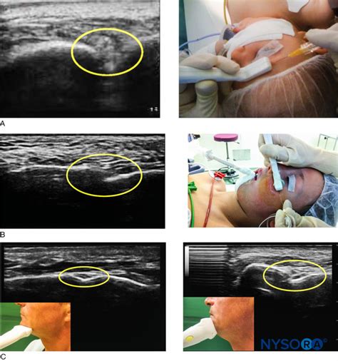 regional-anesthesia-ultrasound-imaging-for-superficial-trigeminal-nerve ...