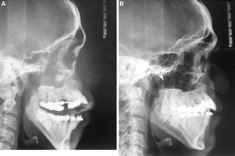 An instance of anterior open bite. A, Anterior open bite after ...