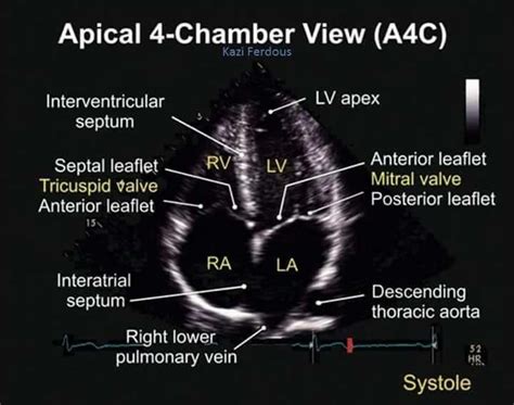 Apical 4 Chamber View TEE | Diagnostic medical sonography, Diagnostic ...