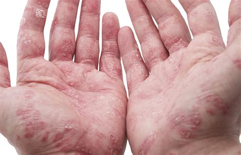 The Link Between Psoriasis And Arthritis |Summit Orthopedics