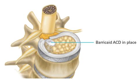 Barricaid Annular Closure Device | Dr. Stieber, MD