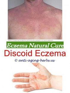 Eczema Lotions