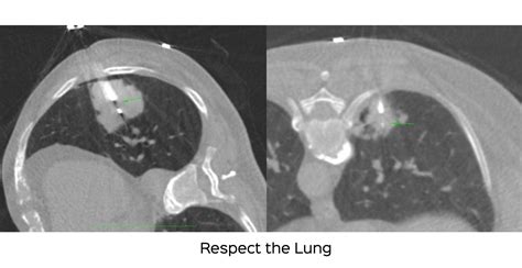 Lung Nodule Biopsy