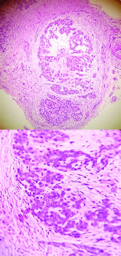 Microscopic description of glomus tumor. | Download Scientific Diagram