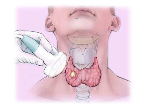 Thyroid Biopsy — The Interventional Initiative