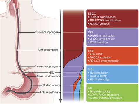 Study Points to Genetic Subtypes of Esophageal Cancer - NCI