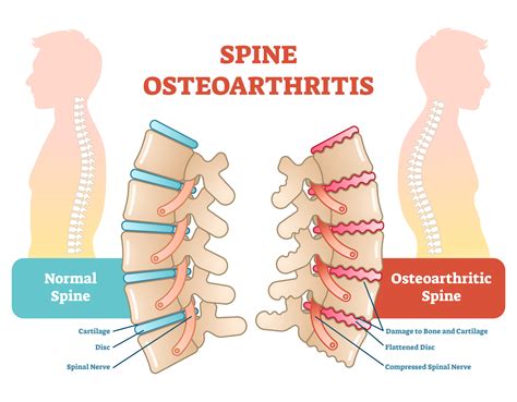 What is Osteoarthritis, and How Does it Affect My Spine?