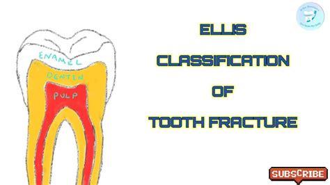 Tooth Fracture Classification