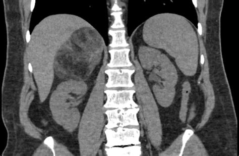 Adrenal Myelolipoma Ultrasound