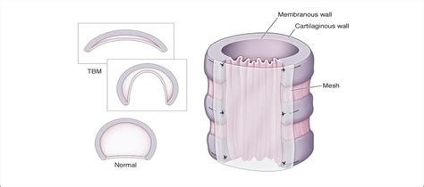 Tracheobronchomalacia: A Rare Lung Disease | Temple Health