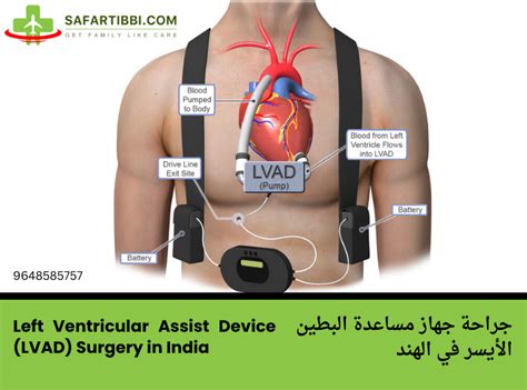 Left Ventricular Assist Device (LVAD) Surgery in India - Safartibbi