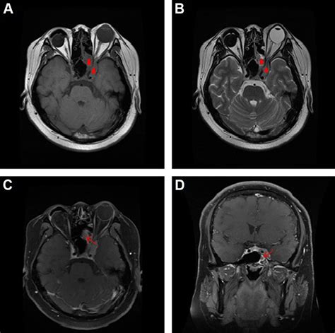 Magnetic resonance images of the cavernous sinus. Notes: axial T1... | Download Scientific Diagram