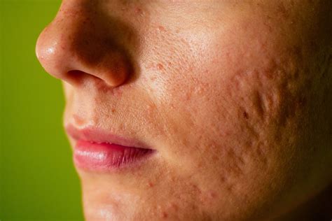 3D imaging technique measures severity of atrophic acne scars