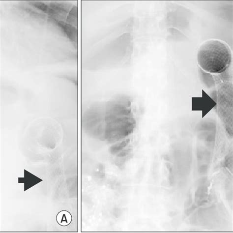 Main Complications after Colonic Stent Placement | Download Table