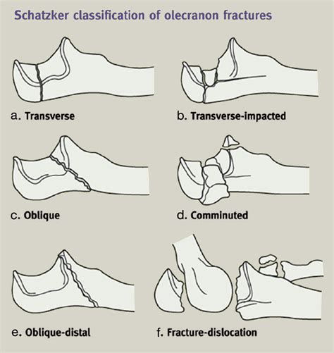 Fractures of the proximal radius and ulna - Orthopaedics and Trauma