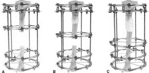 The evolution of the Ilizarov technique: part 2: the principles of ...