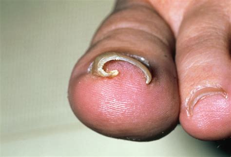 Ingrown Toenail Treatment | Sutherland Podiatry Centre