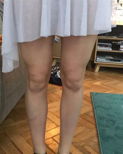 Teenage girl's knees looks like they have two baby faces trapped inside them - Mirror Online