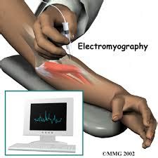 Electromyography (EMG) Doctor NYC - Best Pain Doctor NYC