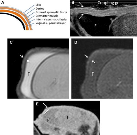 Normal anatomy of the scrotal wall (arrows). A, Diagram showing the ...