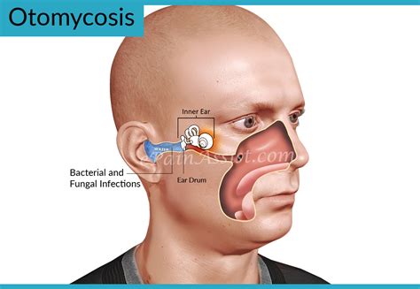 Otomycosis or Ear Fungus: Treatment, Home Remedies, Causes, Signs