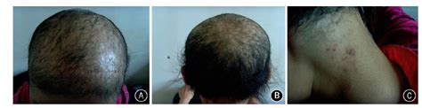 Mutation detection of type II hair cortex keratin geneKRT86i... : Chinese Medical Journal