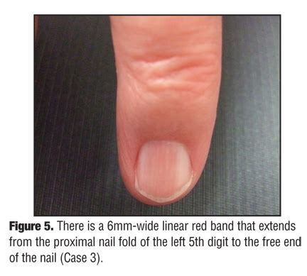 Melanoma Under Nail Bed - Nail Ftempo