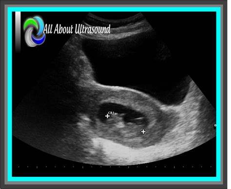 5 Best Practice Tips to OB GYN Ultrasound