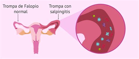 ¿Qué es la salpingitis? - Causas, síntomas y tratamiento