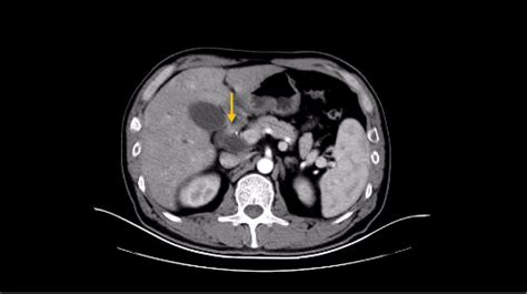 Frontiers | Case Report: A case of advanced duodenal adenocarcinoma in complete remission after ...