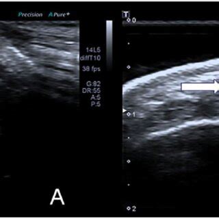 Ultrasound images of the cephalic vein (arrow) displayed via two... | Download Scientific Diagram