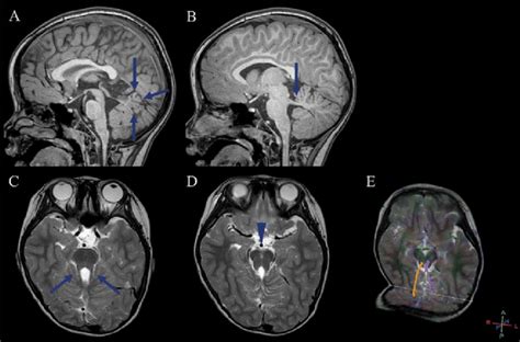 Magnetic resonance imaging findings in a patient with Joubert syndrome.... | Download Scientific ...