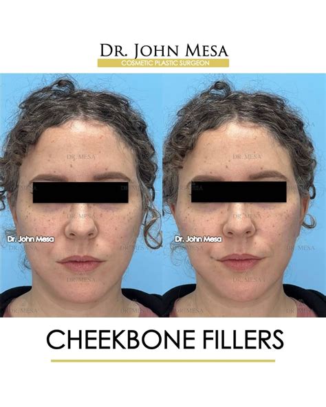 Cheekbone Filler Before & After Photos | Dr. Mesa