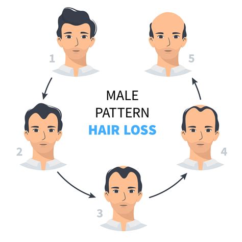 Hair loss stages, androgenetic alopecia male pattern. Steps of baldness ...