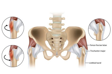 Lateral Hip Pain - Causes, Symptoms, and Treatment - Health Report