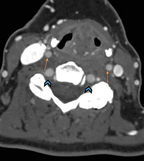 Internal Carotid Artery Ct Scan