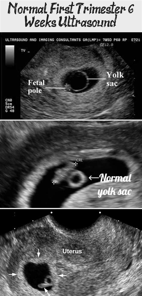 6 Week Transvaginal Ultrasound