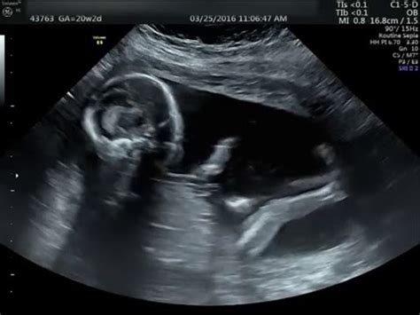 20 week Ultrasound (Its a boy) | วิธีอ่าน ฟิล์ม อัลตร้าซาวด์ - STC EDU