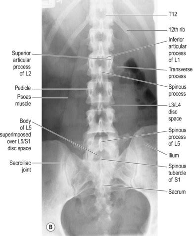 Lumbar Spine X Ray Anatomy