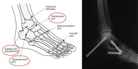 Triple Fusion Surgery of Foot | Peter Rosenfeld FRCS, London