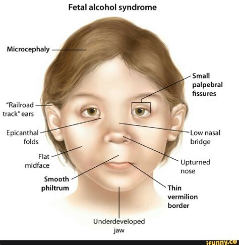 Fetal alcohol syndrome Microcephaly Small palpebral fissures "Railroad track" ears Epicanthal ...